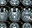 Día de los Tumores Cerebrales