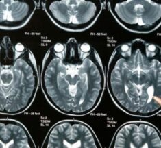 Sociedad de Neurocirugía de Chile adhiere al Día Internacional de los Tumores Cerebrales
