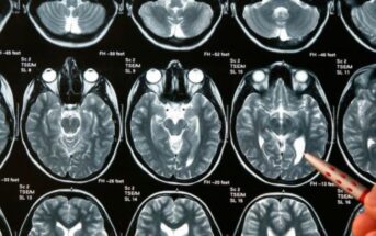 Día de los Tumores Cerebrales