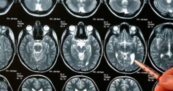 Día de los Tumores Cerebrales