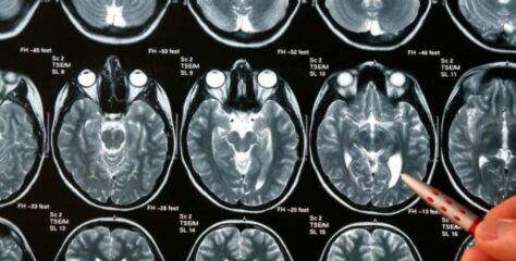 Sociedad de Neurocirugía de Chile adhiere al Día Internacional de los Tumores Cerebrales