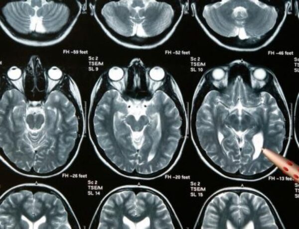 Sociedad de Neurocirugía de Chile adhiere al Día Internacional de los Tumores Cerebrales