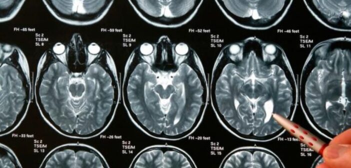 Día de los Tumores Cerebrales